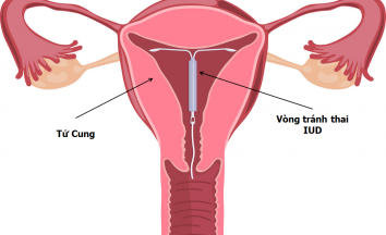 Cách hoạt động của vòng tránh thai