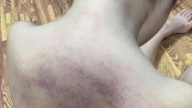 Hải Phòng: Kết luận vụ bé 5 tuổi bị bầm tím ở lưng sau khi đi học