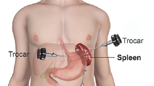 Tại sao người ta thường cắt lá lách?
