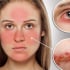 Làm sao để nhận diện và xử lý sớm bệnh tự miễn