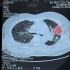 Hà Nội: Bệnh nhân nữ 53 tuổi nhập viện với phổi xuất hiện nhiều ổ áp xe sau 1 tuần mắc sốt xuất huyết