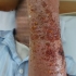 Hà Nội: Người đàn ông bị dị ứng sau khi rắc thuốc lên vết thương do mèo cào