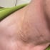 Phú Thọ: Phát hiện thêm ca mắc bệnh giun rồng