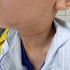 Hà Nội: Cấp cứu cho bệnh nhi bị tai nạn hi hữu trong sinh hoạt