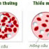 Ăn đa dạng - giải pháp tự nhiên cho người thiếu máu và thiếu sắt