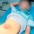 Phú Thọ: Hậu quả nguy hiểm khi tự ý đắp thuốc nam cho trẻ nhỏ