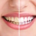Làm trắng răng tự nhiên với dầu dừa