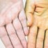 Biểu hiện của viêm gan B giai đoạn đầu: Cảnh báo thầm lặng cần lưu ý