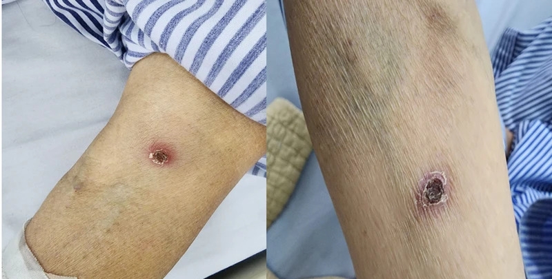 Điều trị cho bệnh nhân nữ 71 tuổi bị sốt mò có bệnh nền đái tháo đường