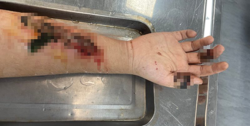 Hà Nội: Thanh niên 17 tuổi đắp lá vào vết thương hở khiến hoại cánh tay và bàn tay