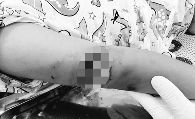 Thừa Thiên Huế điều trị cho bé gái 7 tuổi bị chó dữ tấn công
