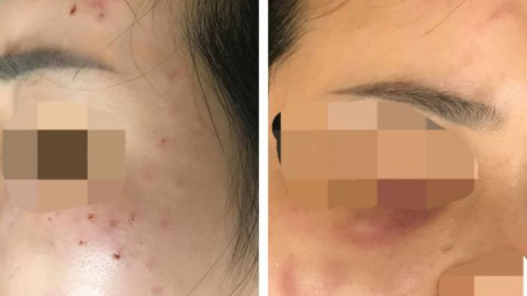 Cô gái đi tiêm meso bị chủ spa tiêm nhầm sữa rửa mặt vào da