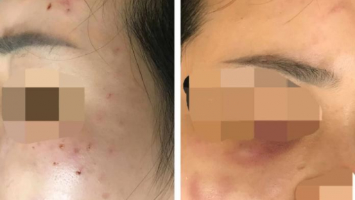 Cô gái đi tiêm meso bị chủ spa tiêm nhầm sữa rửa mặt vào da