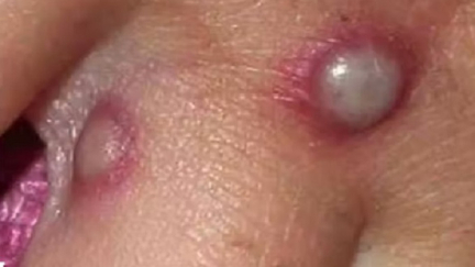 Thêm nhiều quốc gia châu Âu phát hiện các ca mắc đậu mùa khỉ