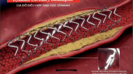Stent tương thích sinh học thế hệ mới giảm biến chứng tim mạch