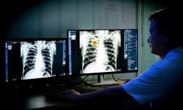 Ứng dụng AI vào ngành y tế hướng đến mục tiêu xóa sổ bệnh lao phổi