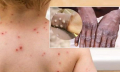 Đậu mùa khỉ: 70 ca tử vong toàn cầu, CDC cảnh báo phương thức lây nhiễm