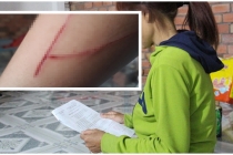 Vụ bé gái bị hiếp dâm tại Bình Chánh: Nạn nhân bị 2 đối tượng bịt mặt chém trên đường