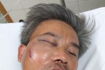 Chụp ảnh hiện trạng, một nhân viên cây xanh ở Huế bị đánh gãy xương hàm trên