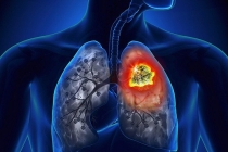 Cảnh báo 5 dấu hiệu không ngờ đến của ung thư phổi