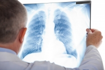 Một vài kiến thức cơ bản về bệnh Lao phổi