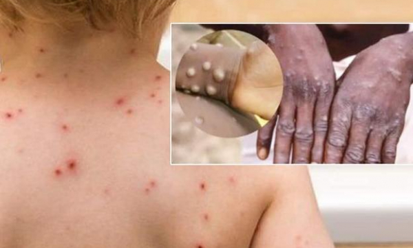 Đậu mùa khỉ: 70 ca tử vong toàn cầu, CDC cảnh báo phương thức lây nhiễm