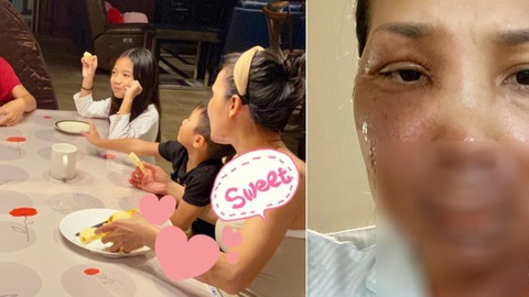 Ca sĩ Hồng Ngọc khiến đồng nghiệp xót xa khi tiết lộ gương mặt bị bỏng