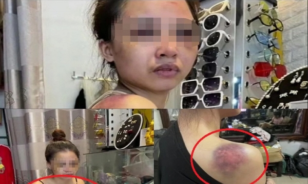 Vợ tố cáo chồng bạo hành cả đêm ở Yên Bái