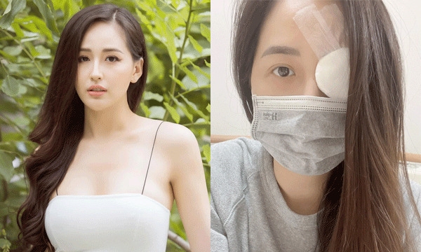 Hoa hậu Mai Phương Thúy gây lo lắng khi đăng ảnh băng kín một mắt