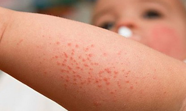Cách nhận biết bị mắc sốt xuất huyết