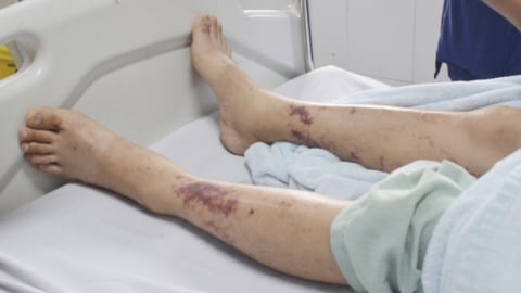 Nhiễm liên cầu khuẩn sau khi ăn lòng lợn luộc chín