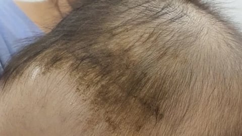 Cứu sống bé 7 tháng tuổi bị tụ máu dưới da đầu ở Bắc Giang