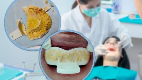 Cô gái suýt ngạt thở vì tự đúc khuôn răng tại nhà bằng bộ dụng cụ giá rẻ mua online