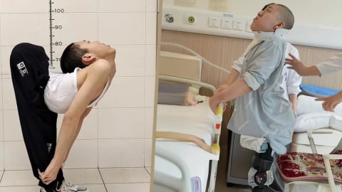 'Cậu bé gập người' ở Trung Quốc lần đầu tiên đứng thẳng sau ca phẫu thuật tái tạo xương