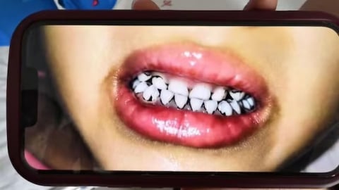 Choáng váng ngộ độc chì hàng loạt tại trường mẫu giáo Trung Quốc