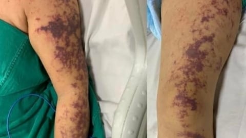 Hà Nội: Người đàn ông mắc liên cầu lợn sau khi làm tóp mỡ