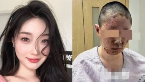 Hotgirl mạng xã hội bị hủy hoại gương mặt vì nổ gas