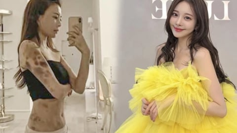Hot girl Hàn Quốc 'thâm tím toàn thân vì tiêm thuốc bổ’ thắng kiện