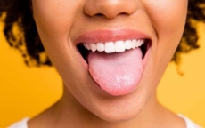 Sưng lưỡi là dấu hiệu của bệnh gì?