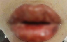Bác sĩ cảnh báo một phụ nữ bị biến chứng với mực xăm môi