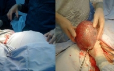 Phẫu thuật thành công khối u nang buồng trứng “khủng” cho 2 bệnh nhân