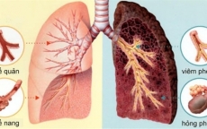 Cách phát hiện ung thư phổi sớm