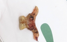 Nuốt phải răng giả, bệnh nhân bị thủng đại tràng