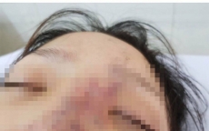 Một nữ sinh có nguy cơ mù mắt vì tiêm filler