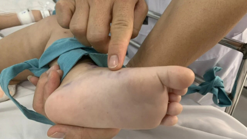 Dịch sởi lan rộng: Cảnh báo lỗ hổng trong phòng dịch cộng đồng