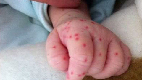 Sốt xuất huyết,  xin chớ xem thường