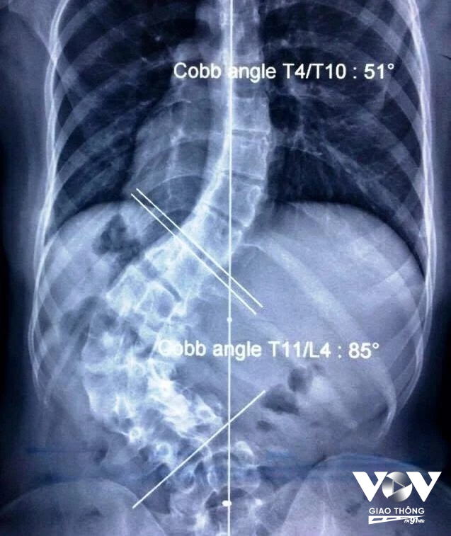 Một ca vẹo cột sống đến gần 90 độ được PGS Võ Văn Thành mổ thành công và được Hội chấn thương chỉnh hình Châu Á - Thái Bình Dương đặt tên V.V.T cho phương pháp mổ độc đáo của riêng bác sĩ.