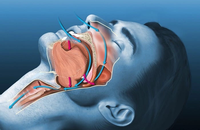 Ngừng thở khi ngủ là tình trạng luồng khí hít vào bị gián đoạn tạm thời hơn 10 giây (Ảnh minh họa: Sức khỏe và Đời sống)