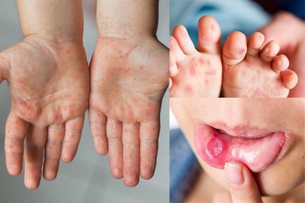 Virus EV71 đã xuất hiện và gây bệnh nặng ở bệnh nhân tay chân miệng tại Việt Nam.
